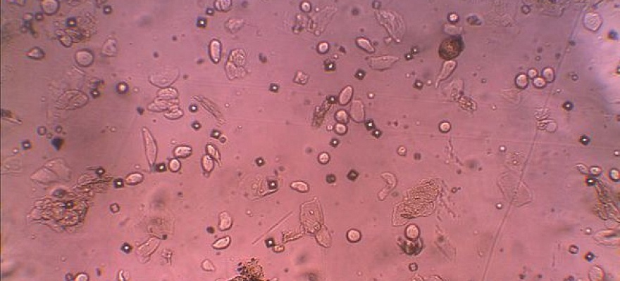 Бактерии и слизь в моче у женщин. Микроскопия мочи бактерии. Аморфные фосфаты под микроскопом. Микроскопия мочи слизь. Ураты под микроскопом.